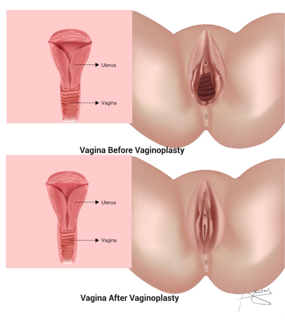 Di Williams Anal en prolapsus