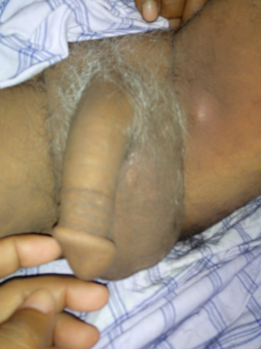 Pénis masculin sans circoncision