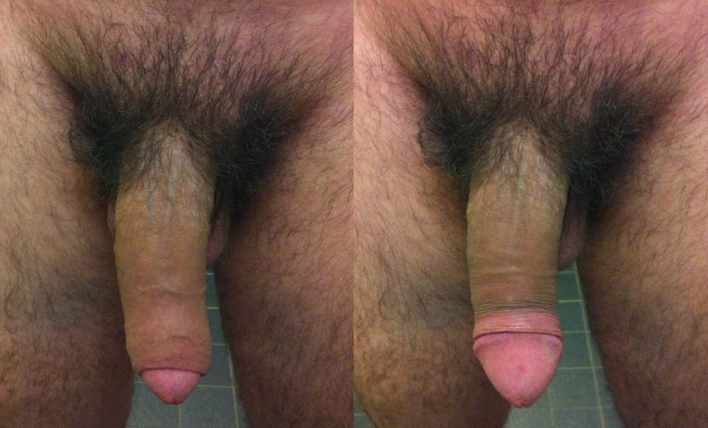 Érection du pénis masculin
